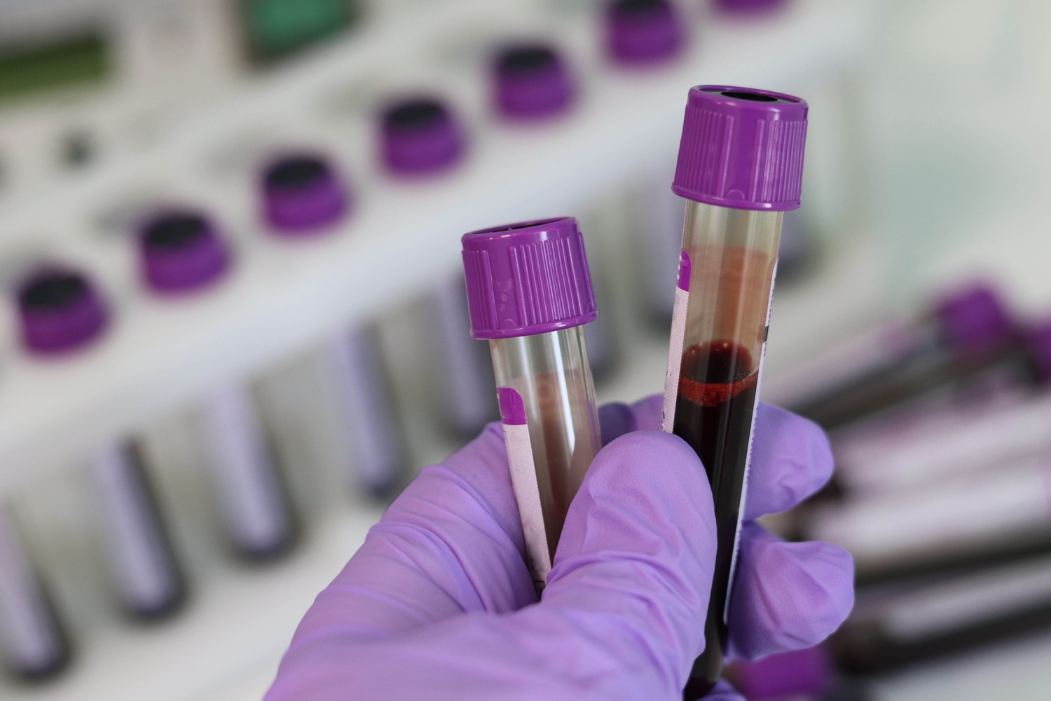 What Does High hsCRP Mean? Understanding high-sensitivity C-reactive protein test results.